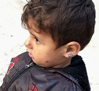 Bild: Kinder mit entz&uuml;ndeten und vernarbten Beinen und Gesichtern