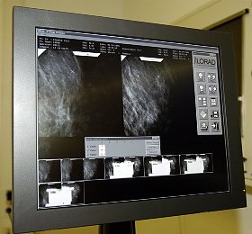 Es trifft jede neunte Frau (Foto: nnz)