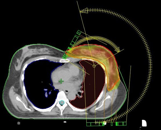 VMAT-Bewegungsbestrahlungstechnik (Foto: S&uuml;dharz Klinikum)