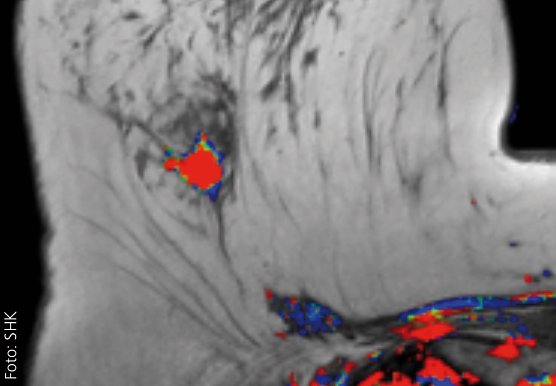 Bildgebung bei Mammokarzinomen (Foto: SHK)