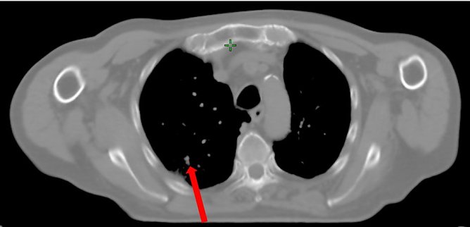 Der Turmor nach der Bestrahlung, nur noch eine Narbe (Foto: SHK) Der Turmor nach der Bestrahlung, nur noch eine Narbe (Foto: SHK)
