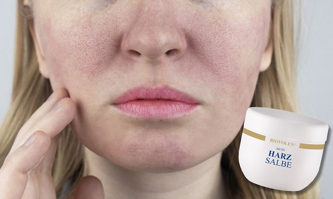 Harzsalbe (Symbolbild) (Foto: Alona Siniehina)