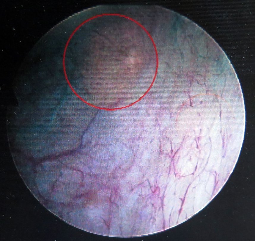 Hier ist nur ein Karzinom erkennbar