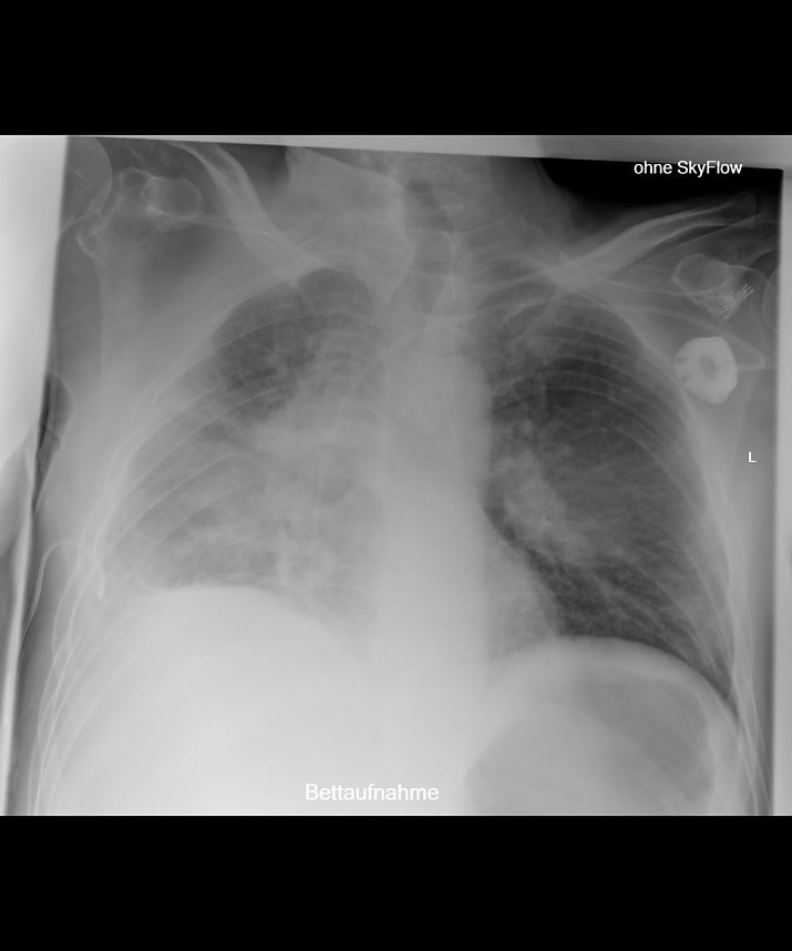 Liegendaufnahme zun&auml;chst ohne SkyFlow Technologie